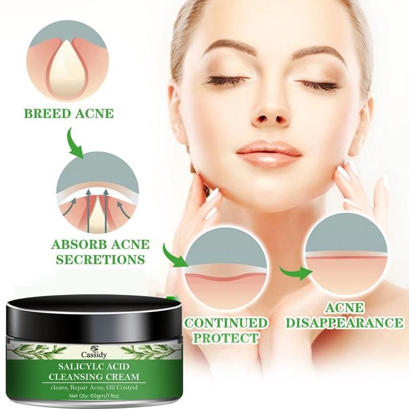 CASSIDY Salicylc Acid Cleansing Cream, 60gm (Pack Of 1)